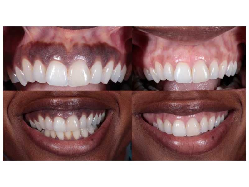 LASER GUM DEPIGMENTATION