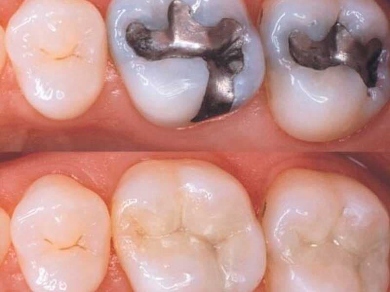 Teeth Space Filling