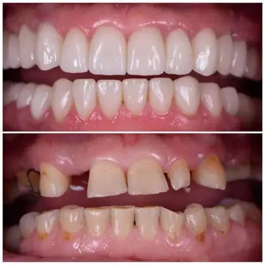 Full Mouth Rehabilitation in Surat Full Mouth Rehabilitation-in-Surat