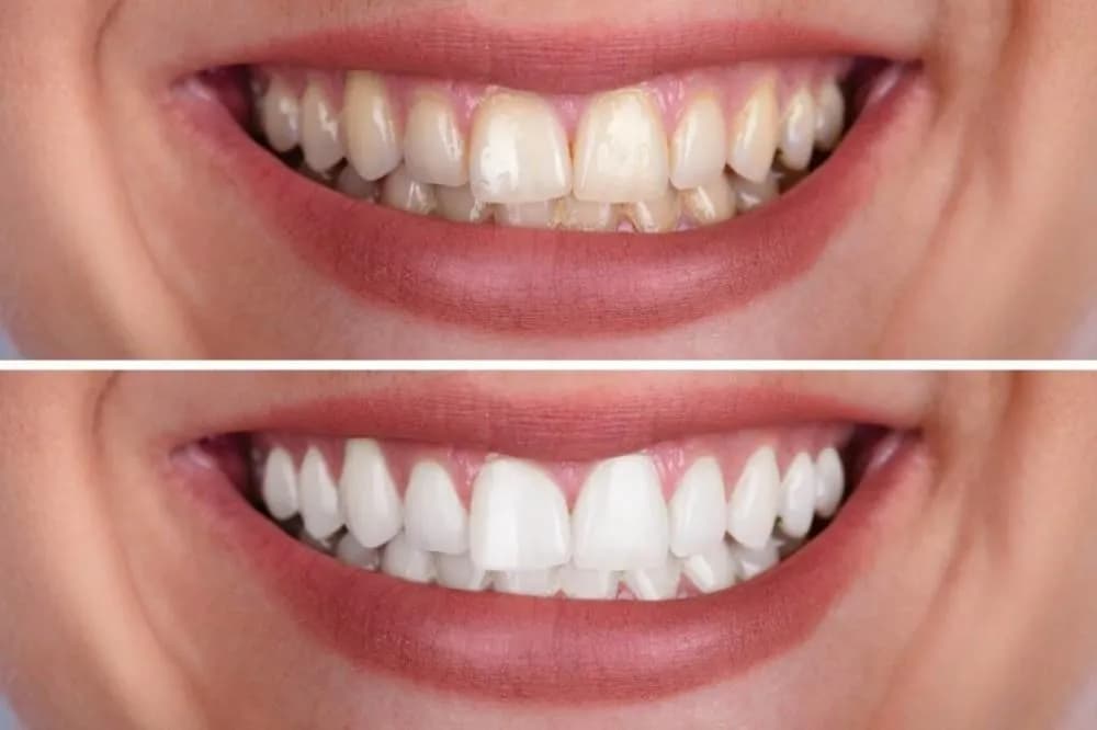 Teeth Whitening / Brightening in Surat Teeth Whitening / Brightening-in-Surat